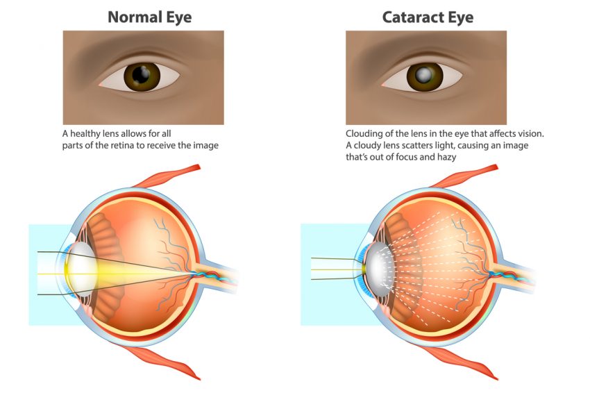 What is cataract surgery and how can it improve your vision? - Oday  Alsheikh MD Braverman-Terry-OEI