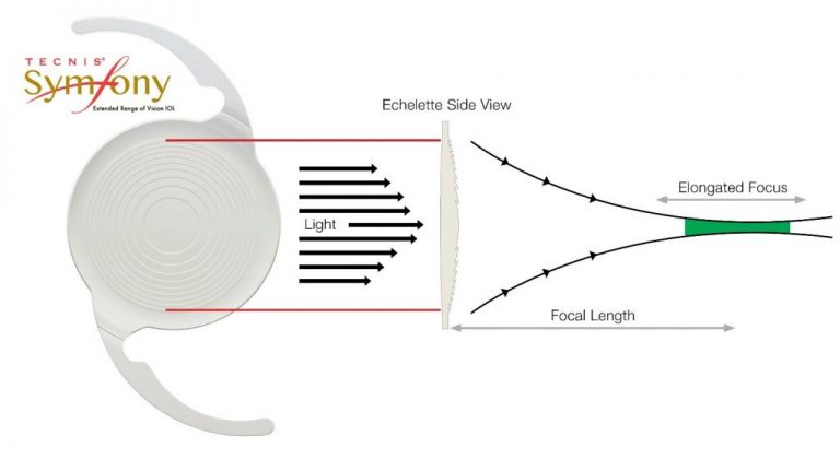 What are the best lens options for cataract surgery? - Oday Alsheikh MD